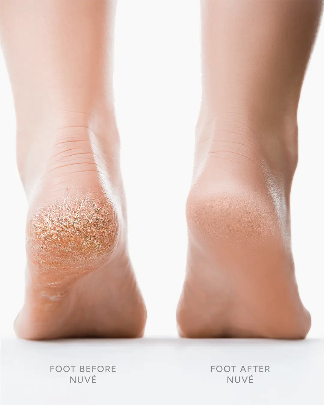 Rough callused foot before using Nuvé Silk 3 Pro vs smooth foot after